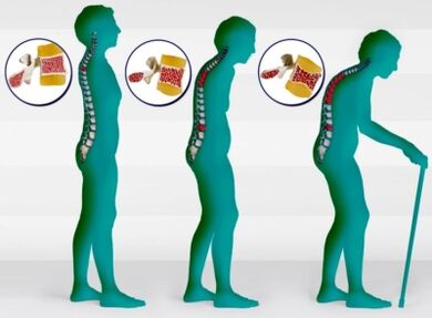 Osteoporoza